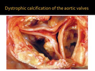 dystrophic calcification 1